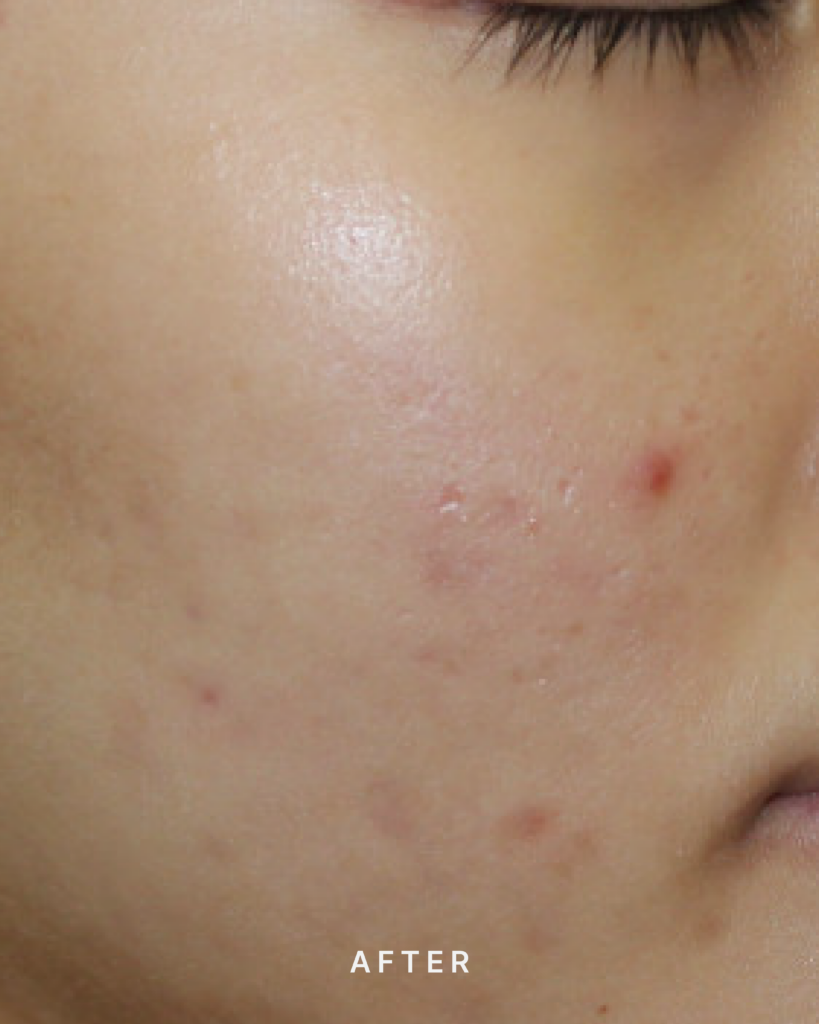 After Acne