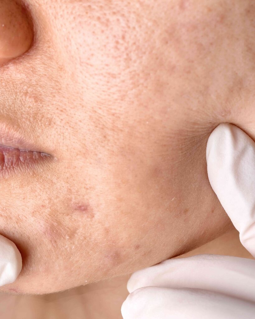 Acne Scar Removal