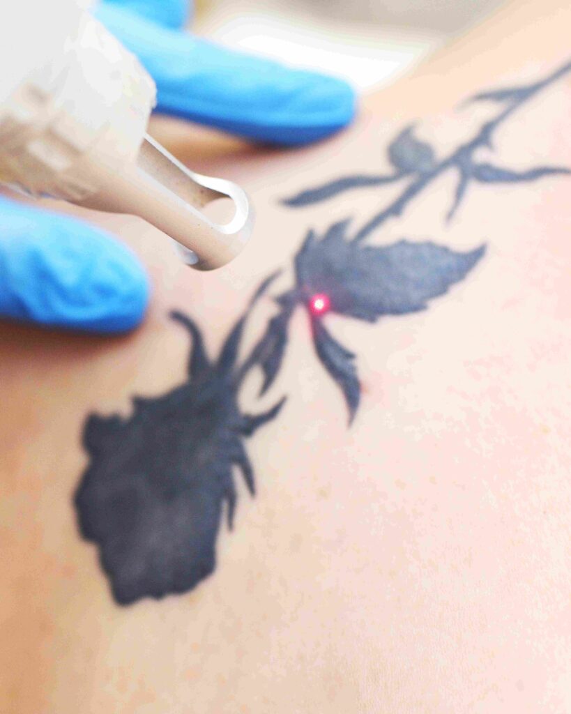 Tattoo Removal